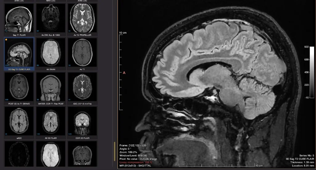 Brain MRI shown in a medical imaging viewer with sagittal scan view