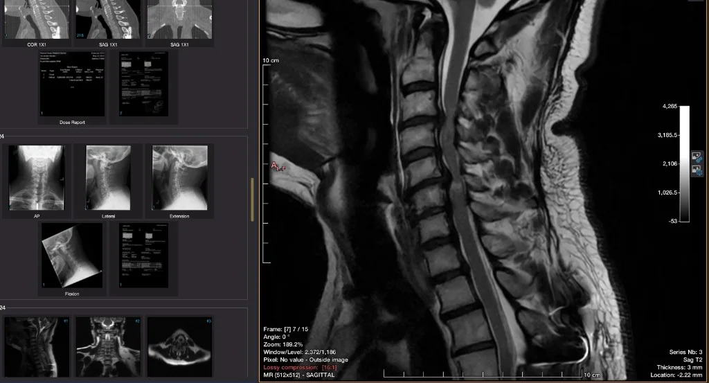 Cervical spine MRI in a viewer with sagittal neck image enlarged and series thumbnails visible