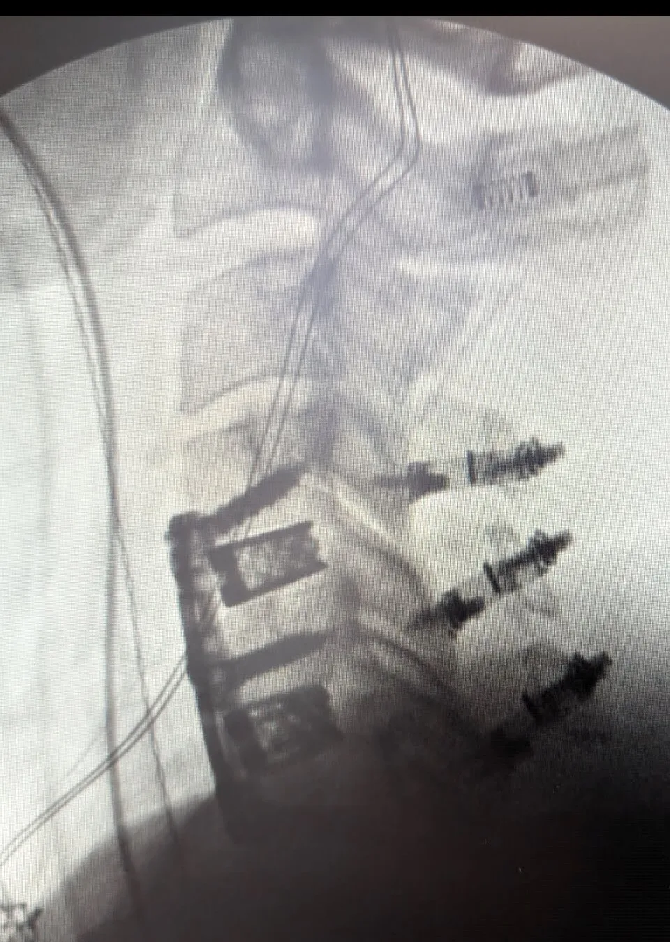 Side-view surgical X-ray showing cervical spine hardware